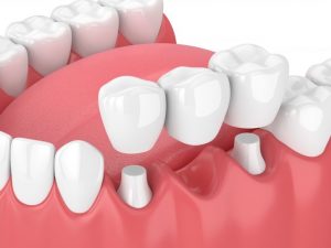 Dental Bridge 768x576