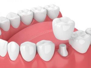 Dental Crown Medium 768x576