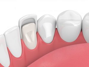 Veneers 768x576