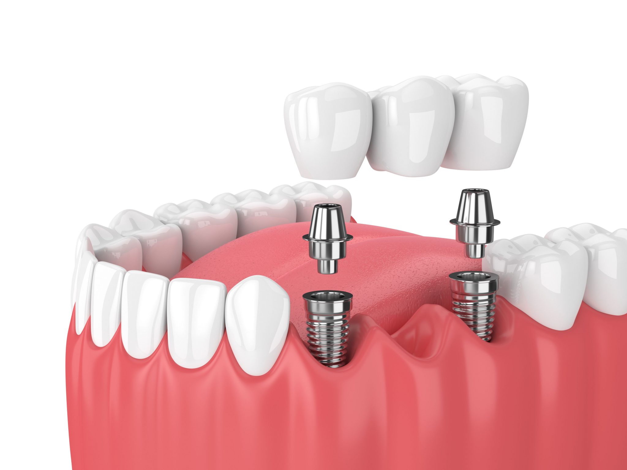 dental implant feat 2