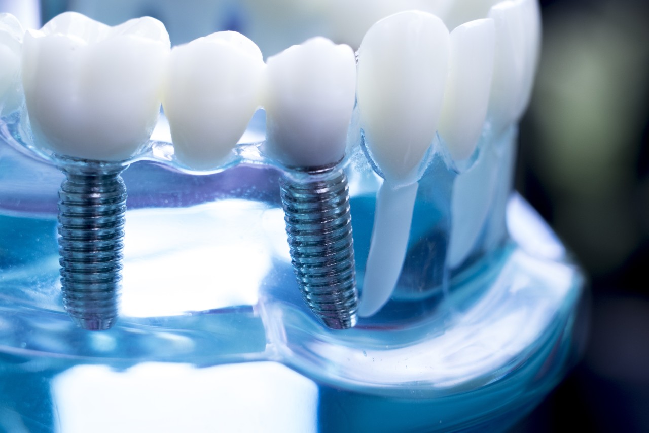 right dentist for dental implants