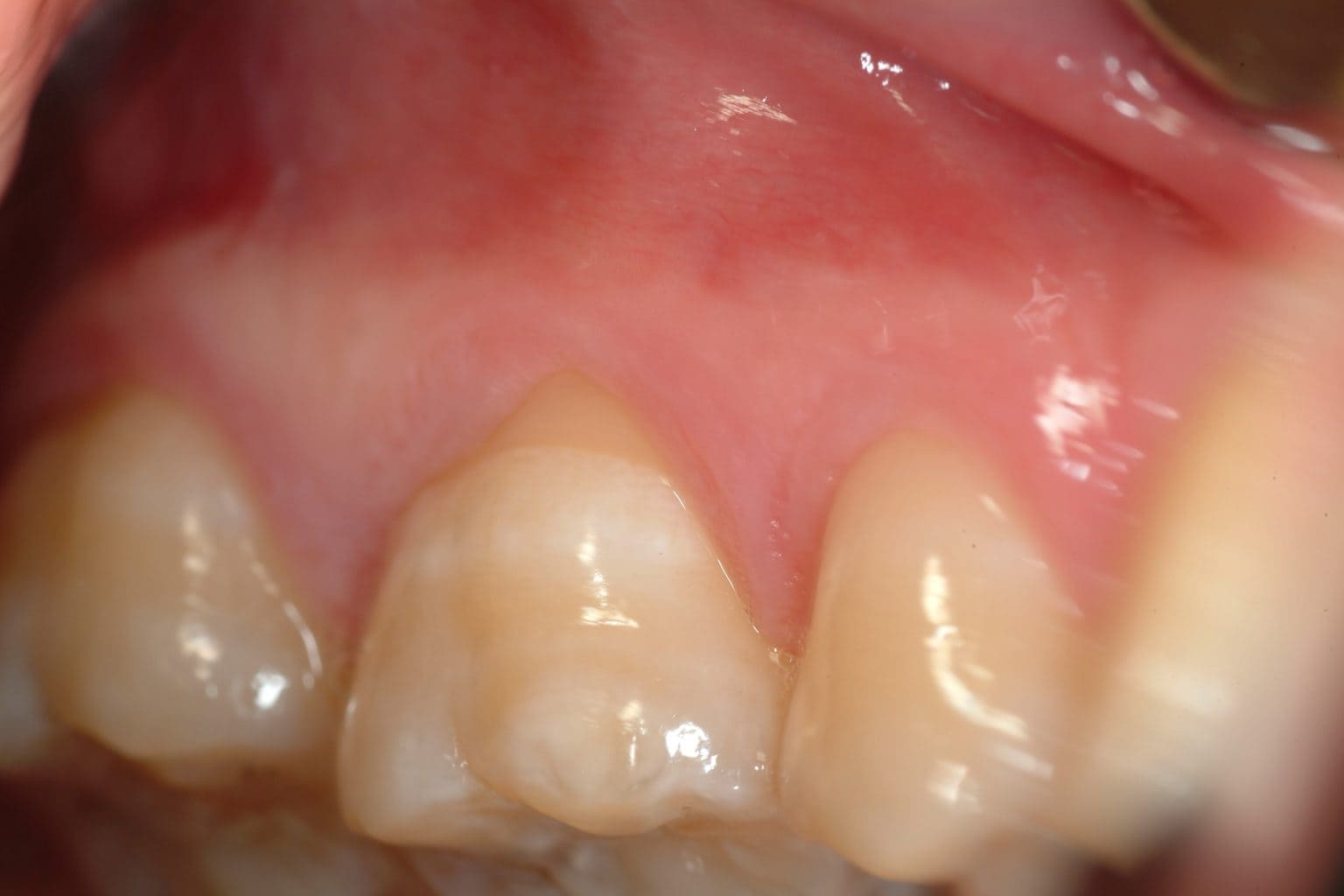 Before