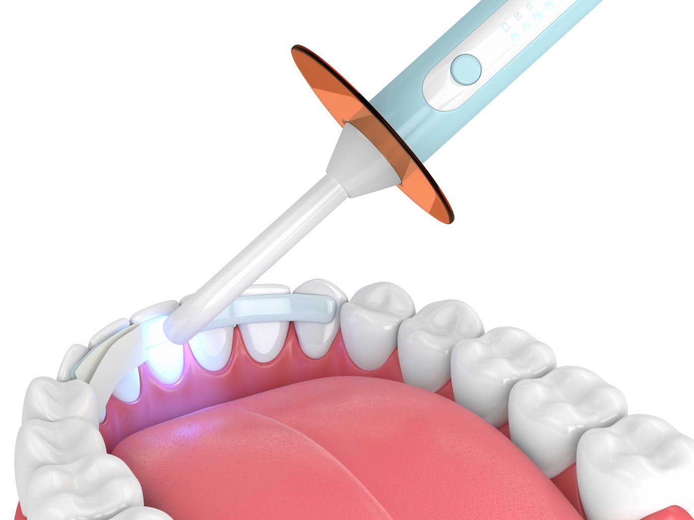 dental bonding 2 1365x1024 new