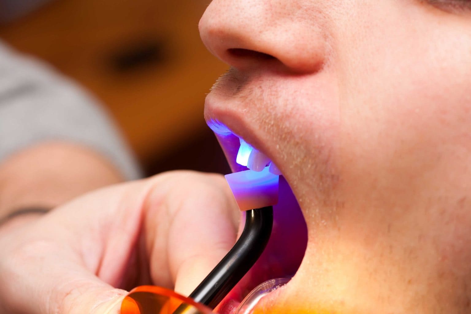 dental bonding 6 1536x1024 new