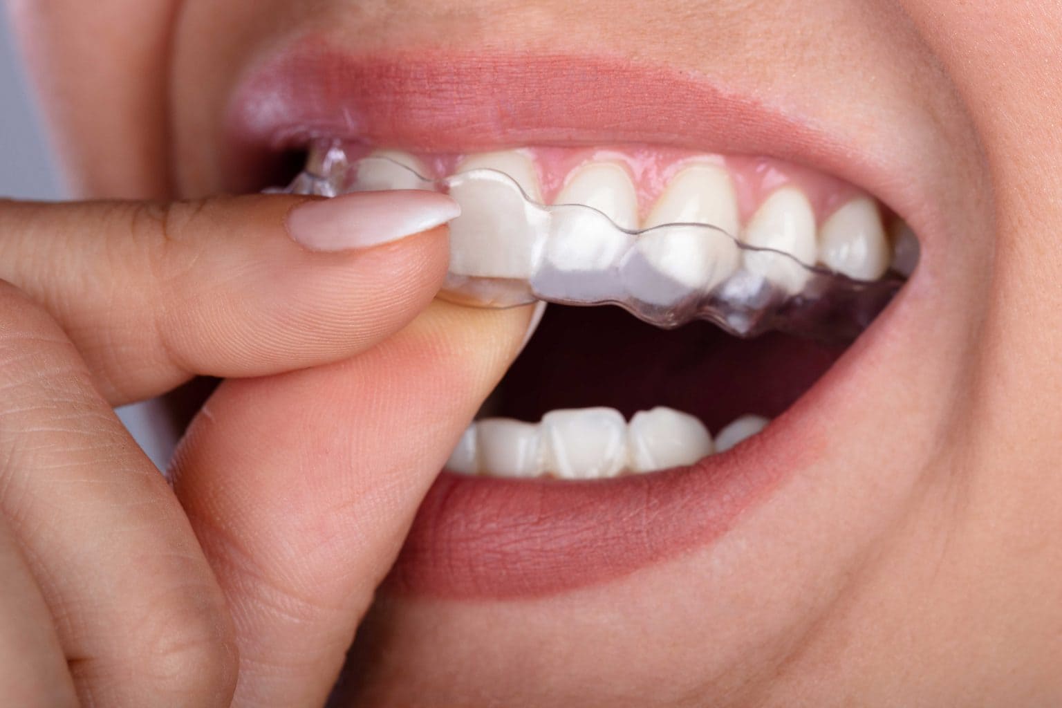 invisalign 4 1536x1024 new