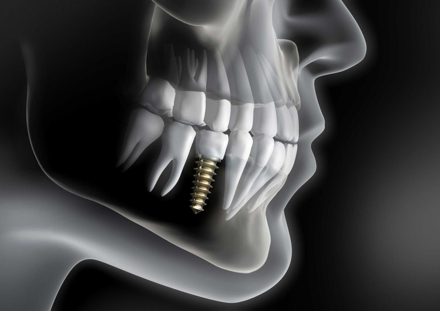 implant 1 1446x1024 new