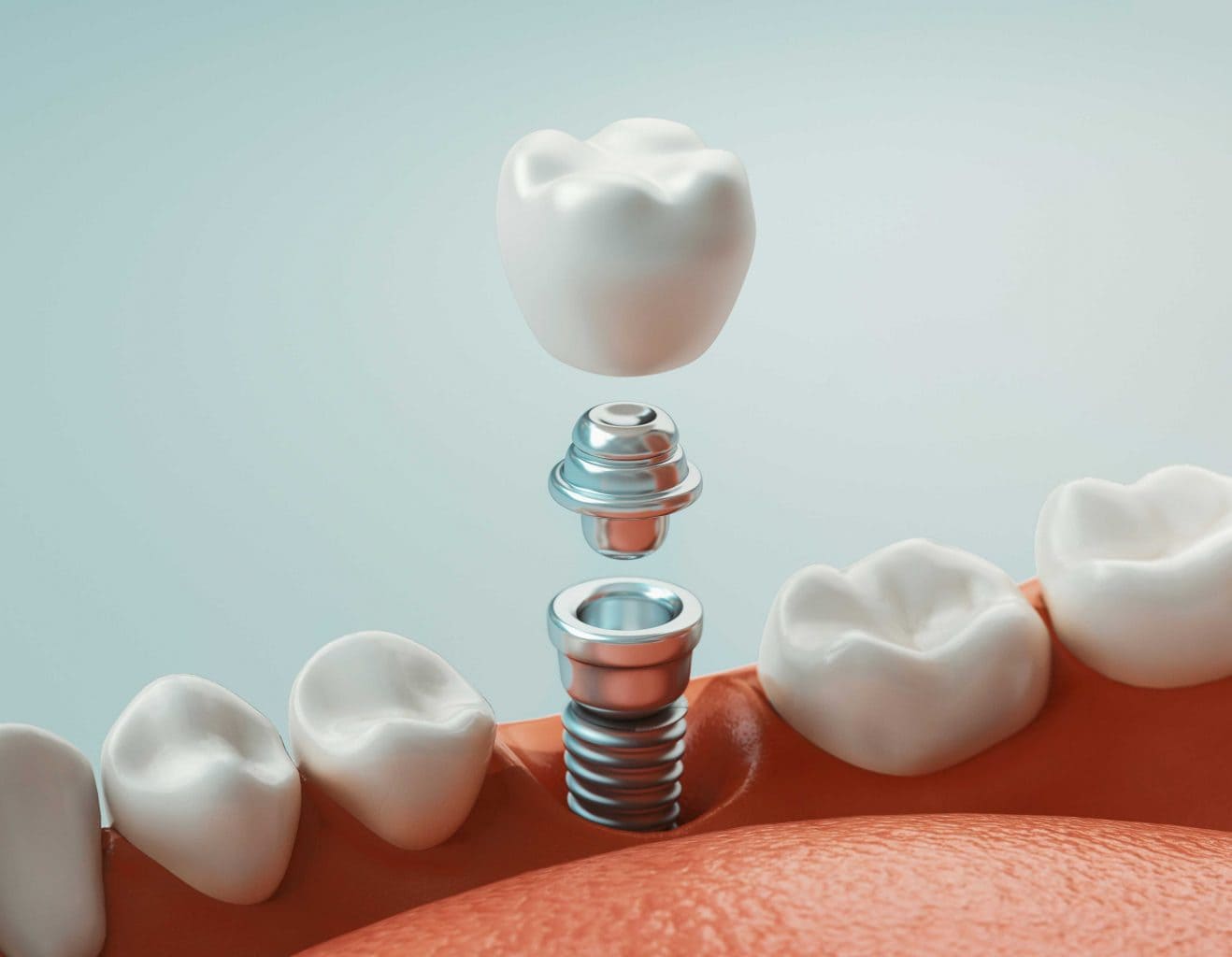implant 3 1318x1024 new