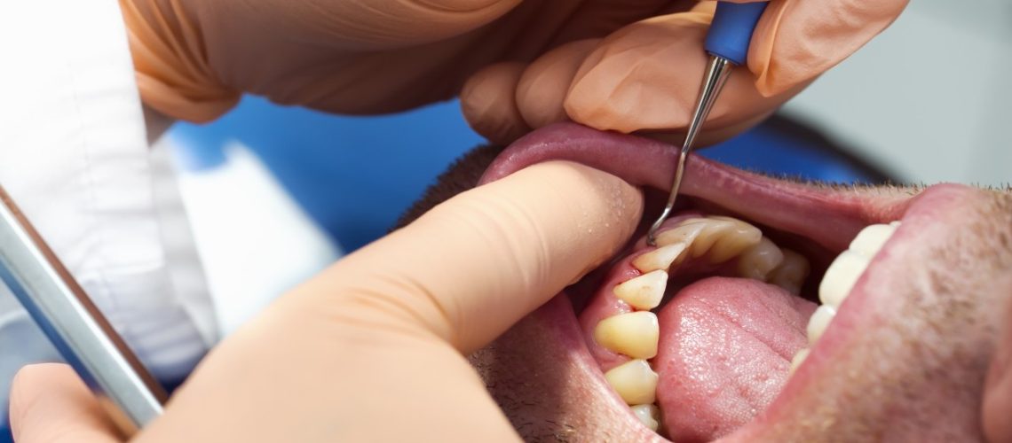 Gum Disease