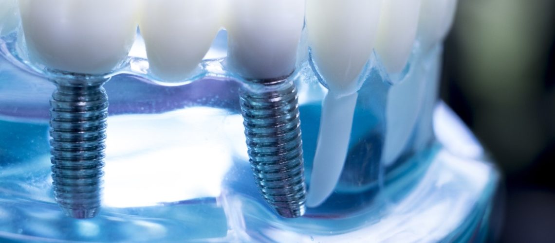 right dentist for dental implants